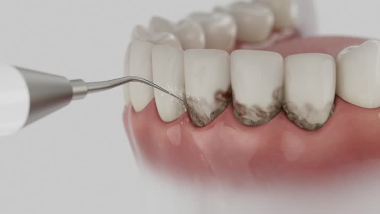 Trusted Wisdom Tooth Removal service in Todd Creek, CO - Dentist Open Now
